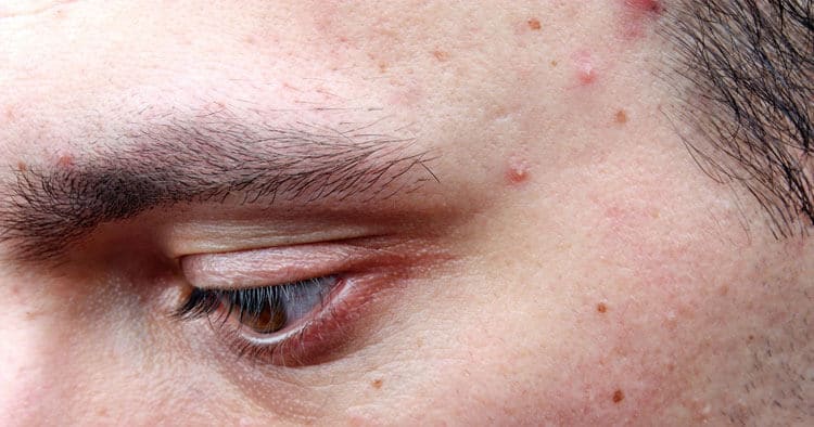 Microdermabrasion for Acne Scars - SkinBase™ Facial