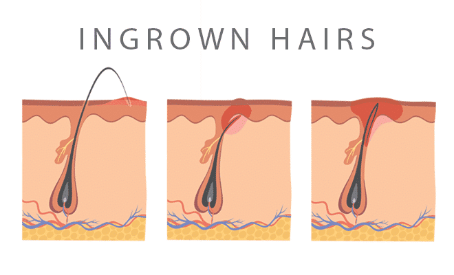 What causes ingrown hairs and how to treat them