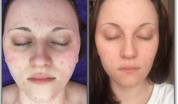 SkinBase Microdermabrasion Tuesday Transformation... - SkinBase™ Facial