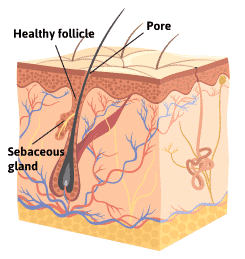 Acne formation diagram 1