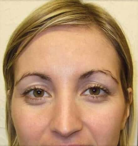 Hannah Slater - after microdermabrasion treatment