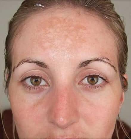 Hannah Slater - before microdermabrasion treatment