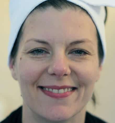 Rachel Dodd - after microdermabrasion treatment