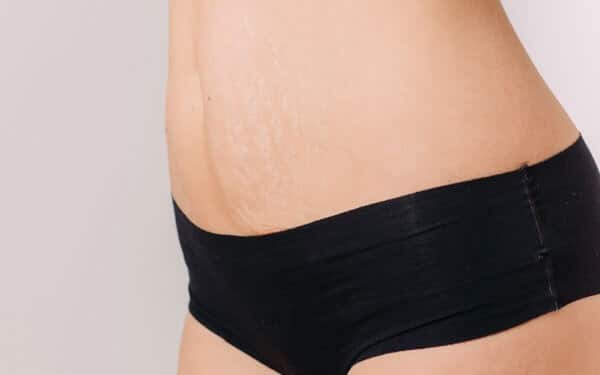 Radio frequency for stretch marks