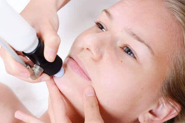 Microdermabrasion treatment