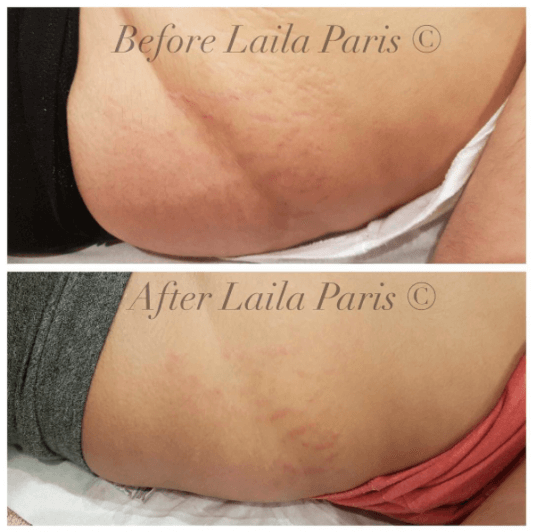 How can microdermabrasion help stretch marks