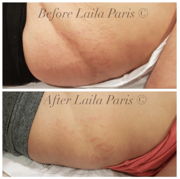 Stretch Marks Remedy And Elimination Choices