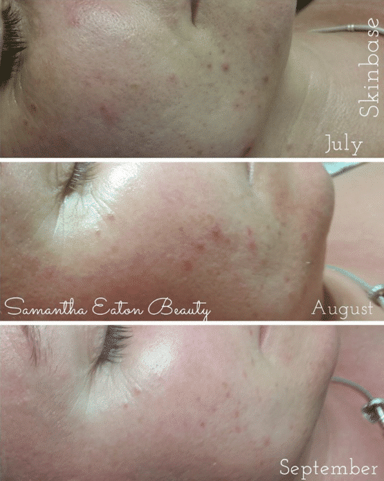 before after skinbase microdermabrasion