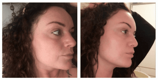 SkinBase microdermabrasion before after