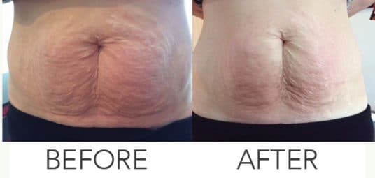 Fantastic Results on Stretch Marks using SkinBase Treatments