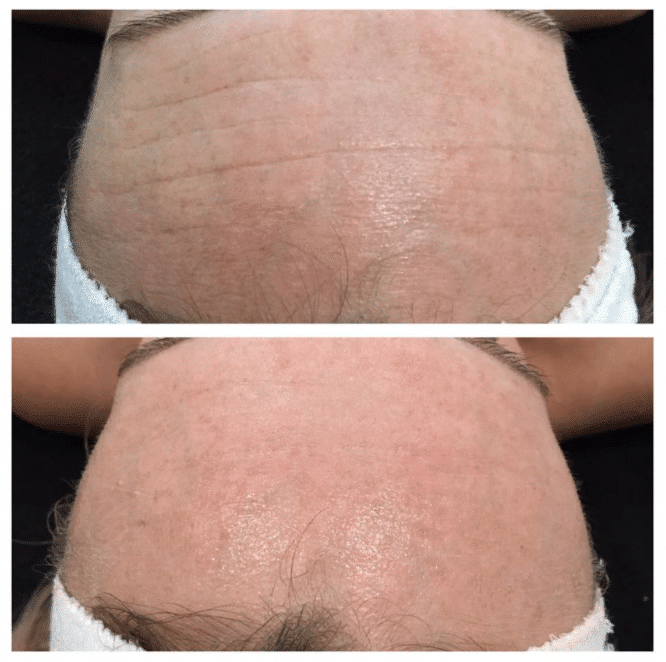 SkinBase microdermabrasion before and after