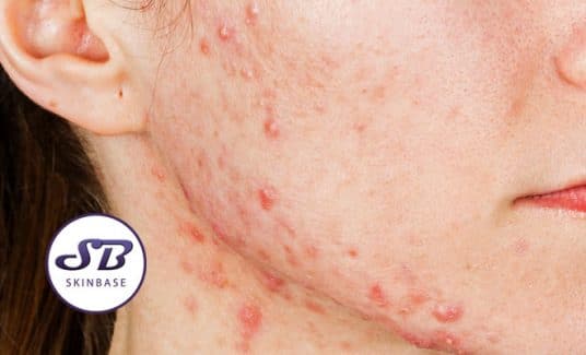 acne scarring