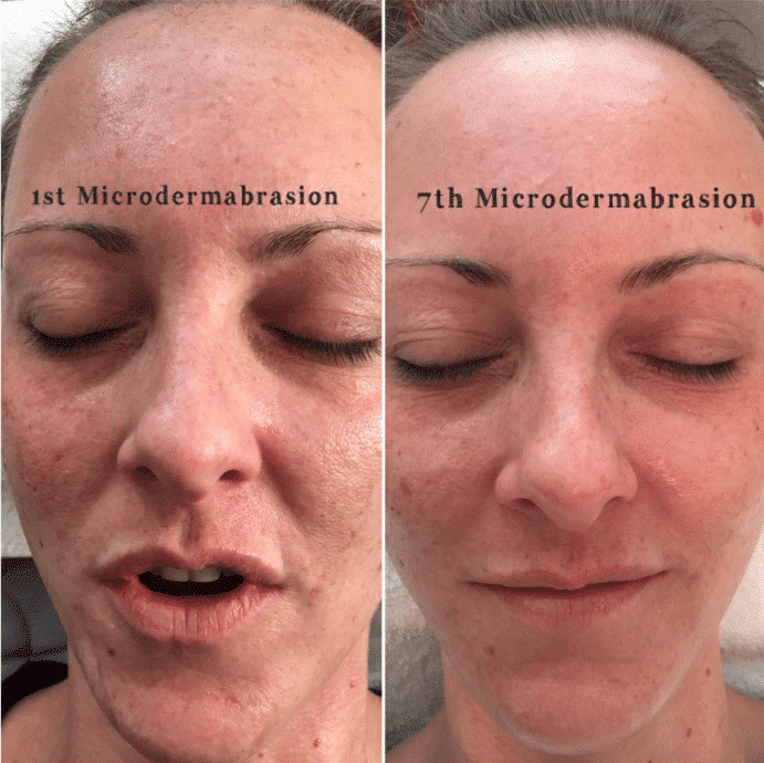 skin pigmentation, Michala Couldrey