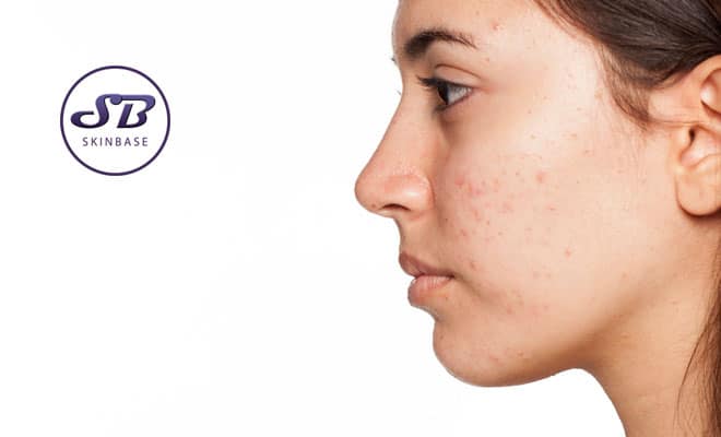concealing acne scars