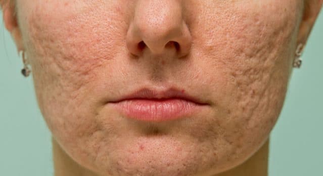 Are we doing enough for acne sufferers?