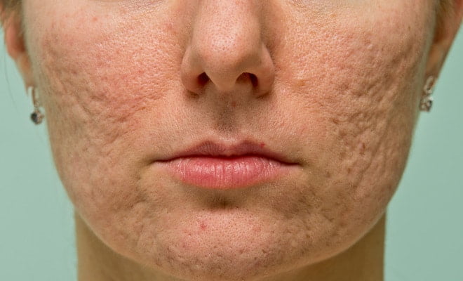 Doing enough for acne sufferers