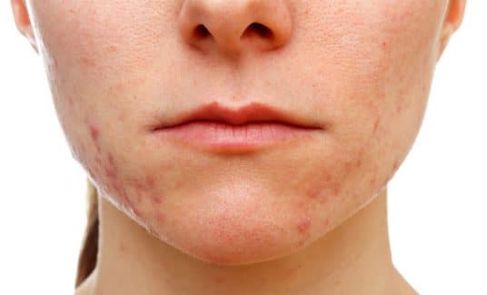 Teenage acne What can we do about it SkinBase Facial