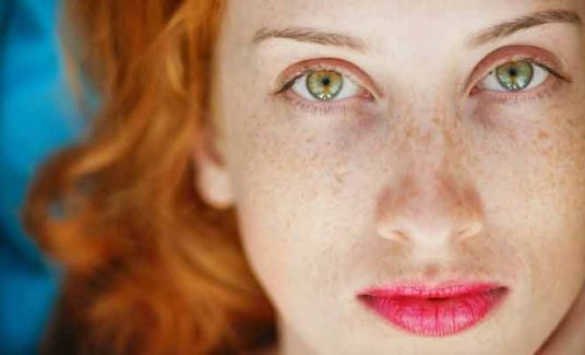 freckles and sun damage