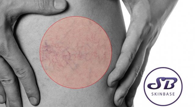 Spider veins – Can we treat them?