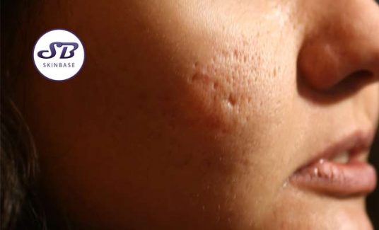 acne scars