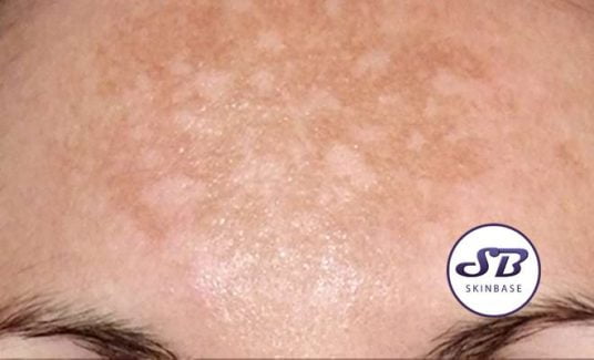 melasma