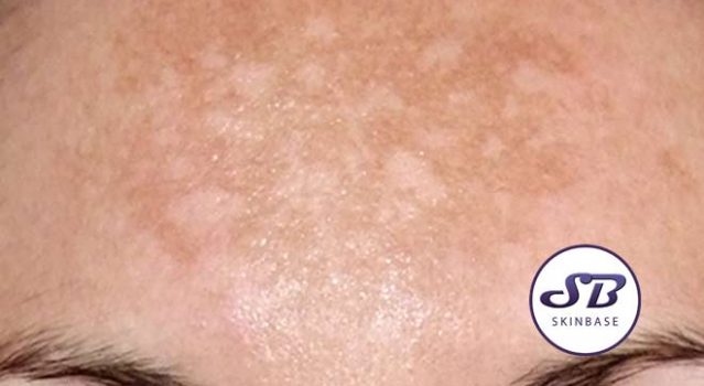 The Melasma (Pregnancy Mask) Skincare Guide
