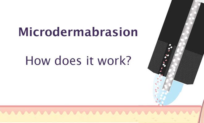 How microdermabrasion works