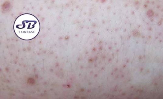 keratosis pilaris