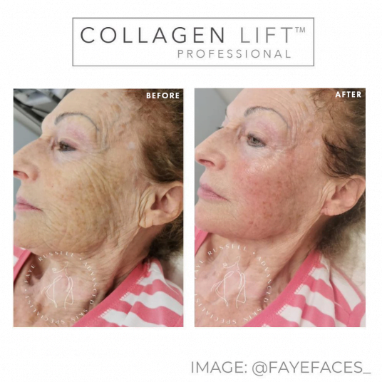 collagen lift before and after