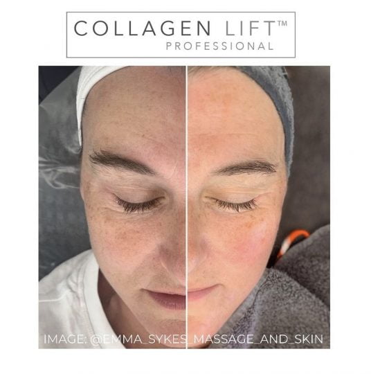 Emma sykes Collagen Lift