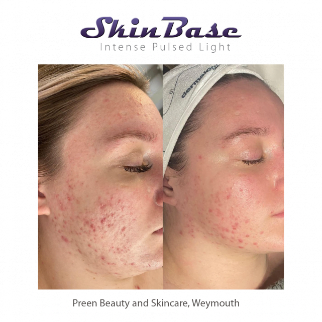 Weekly Transformations IPL for acne