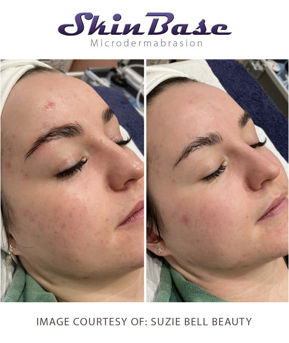 microdermabrasion transformation