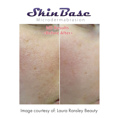 microdermabrasion acne before and after