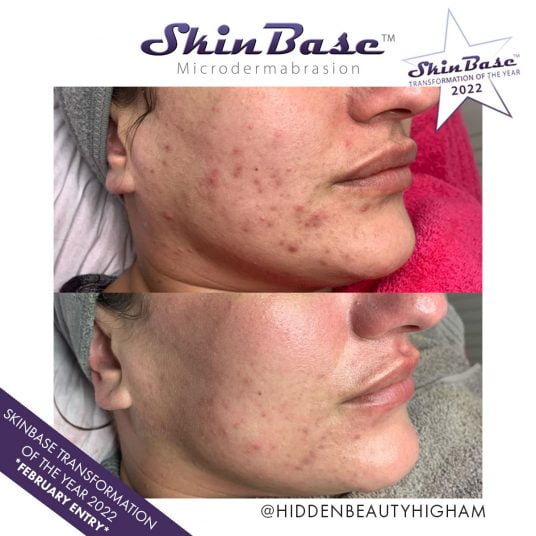 microdermabrasion acne before and after