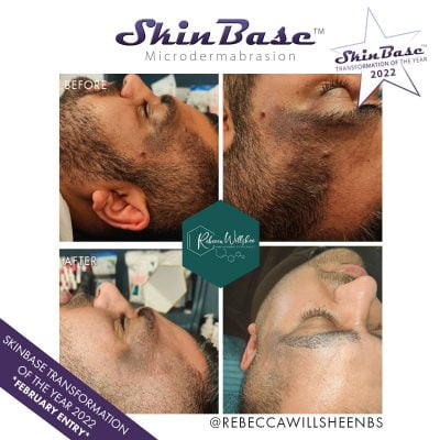 microdermabrasion before and after