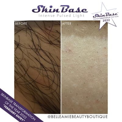 Belle Amie IPL hair reduction