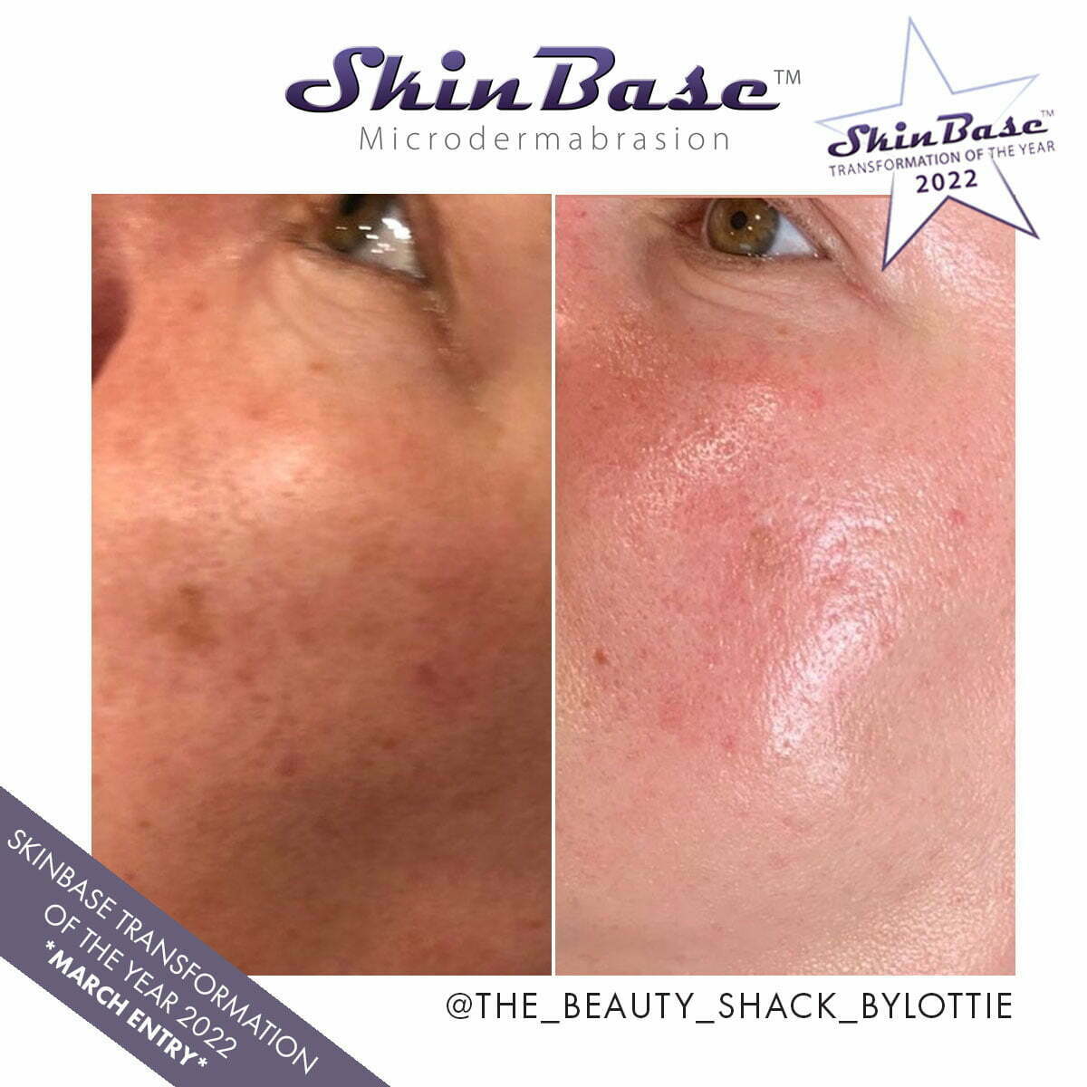 the beauty shack microdermabrasion