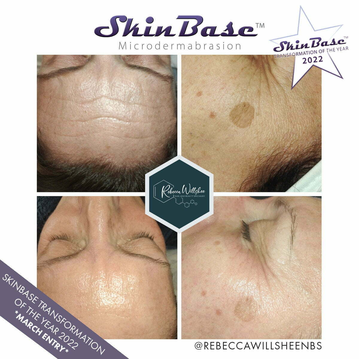 Microdermabrasion Before & After | SkinBase