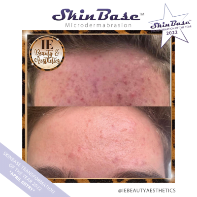 microdermabrasion acne before and after