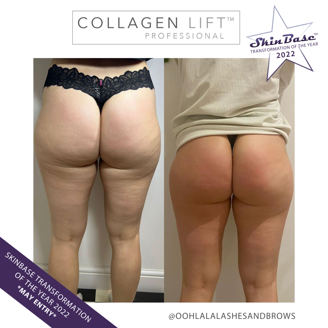 Collagen Lift body treatment