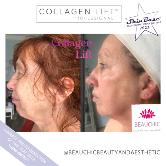 Must See Collagen Lift Transformation