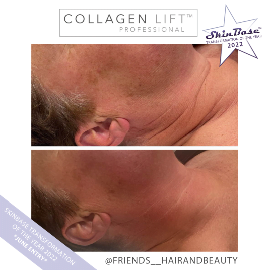 Must See Collagen Lift Transformation