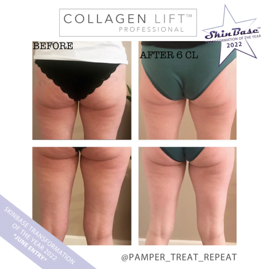 Cellulite Results, Before and After