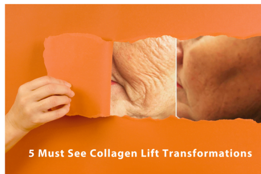 Collagen Lift Transformation
