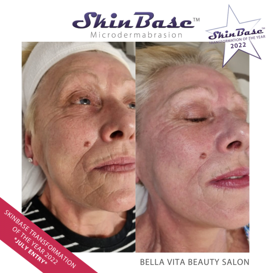 Microdermabrasion Transformation Bella Vita Beauty Salon