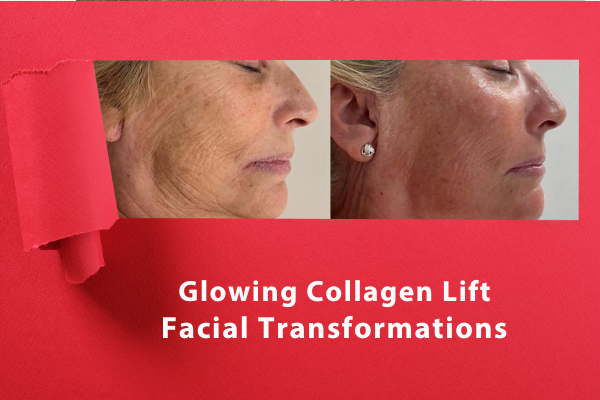 Collagen Lift Facial