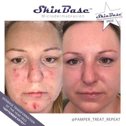 September skincare acne microdermabrasion