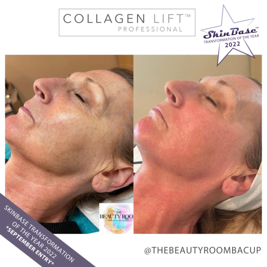 The Beauty Room Collagen Lift Before and After