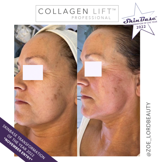 the hive collagen lift results