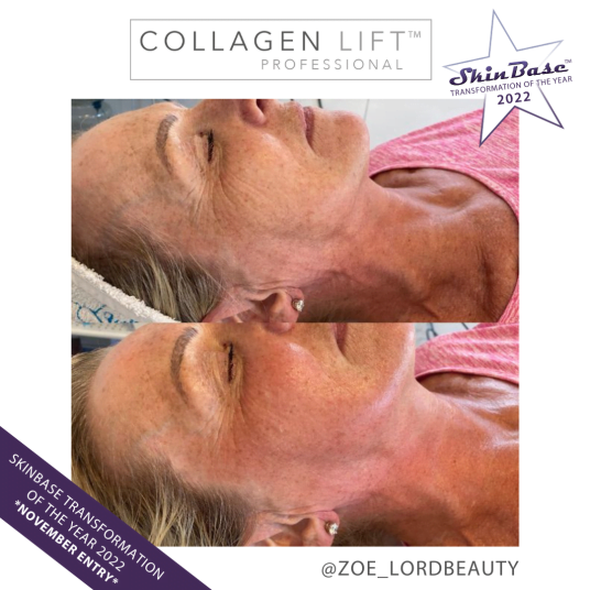 THEHIVE collagen lift
